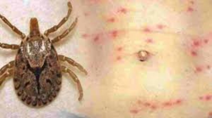 First death due to scrub typhus in Shimla, know the surprising things about this disease