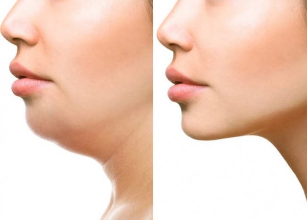 How to Reduce Cheek and Neck Fat? Follow These Tips for a Sculpted Look