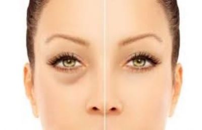 Puffy Eyes: Follow these tips to Reduce Puffy Eyes