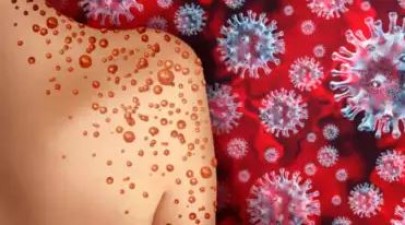 WHO declares monkeypox a global emergency