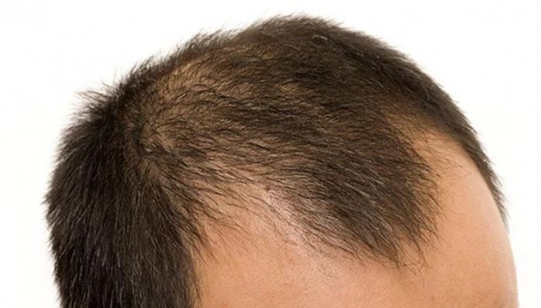 How to Avoid Going Bald? Learn from These 5 Mistakes and Leave Them Behind Today