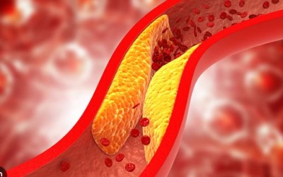 These Symptoms Indicate High Cholesterol: Don’t Ignore Them