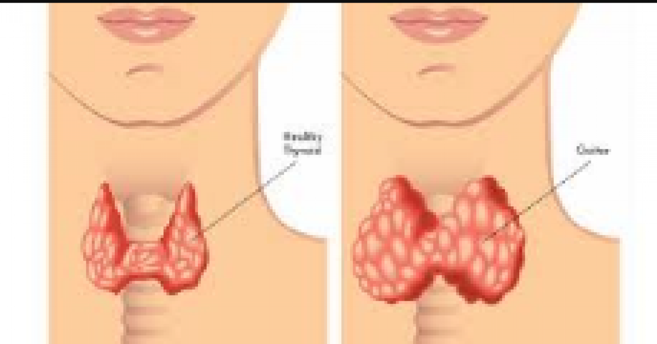 These tips will work to reduce weight increasing  by thyroid