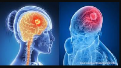 These unusual symptoms are seen in brain tumors, know here