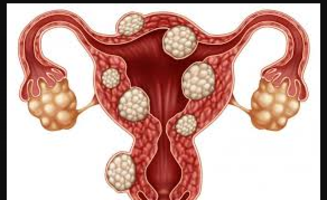 Fibroid problems in women cause sterility, know its treatment