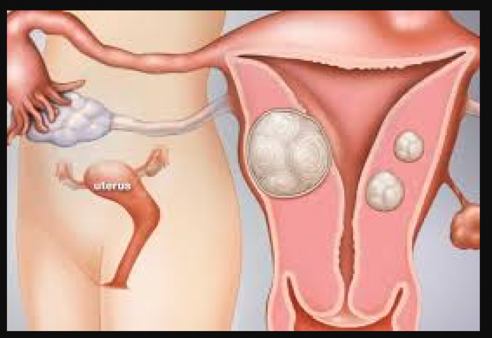 Fibroid problems in women cause sterility, know its treatment