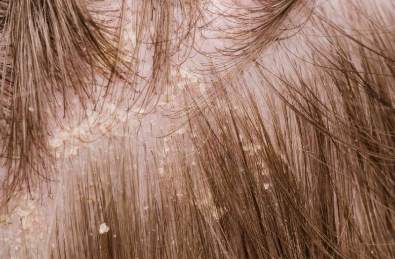 If You're Troubled by Dandruff, Follow These Tricks; Results in Just 15 Days