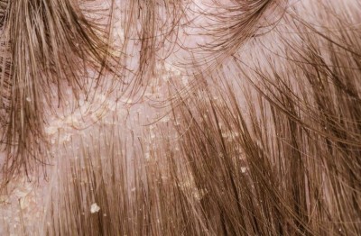 If You're Troubled by Dandruff, Follow These Tricks; Results in Just 15 Days