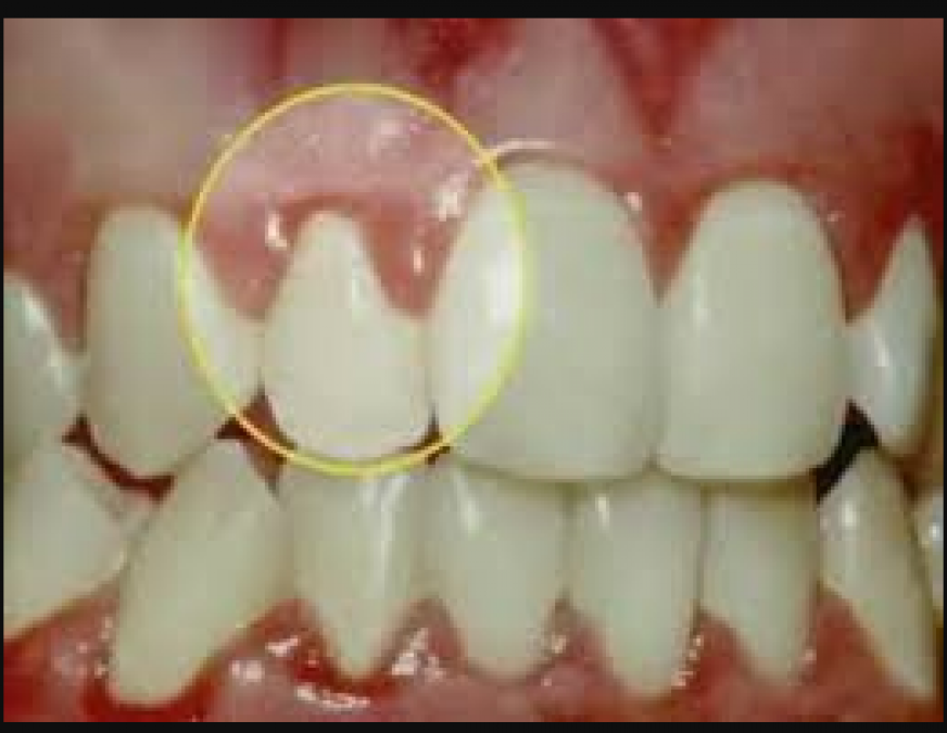 Blackness of the gums points towards these problems, know its treatment