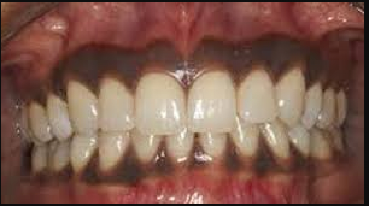 Blackness of the gums points towards these problems, know its treatment