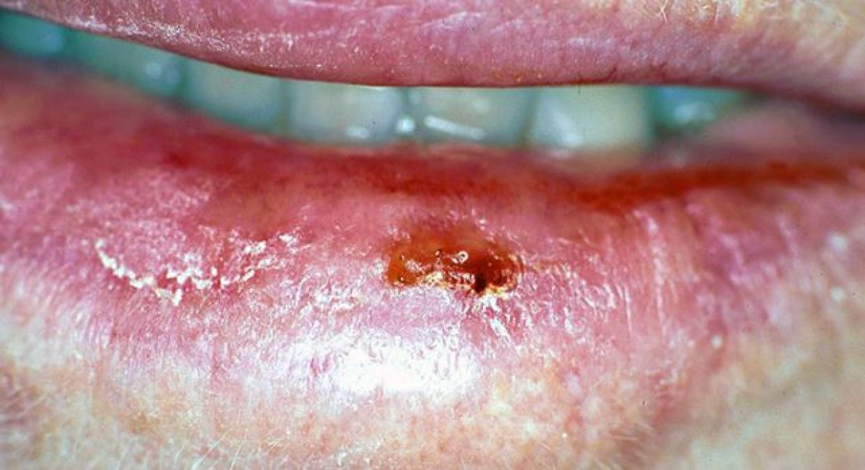 होंठों पर दिखे ये निशान तो हो सकता है कैंसर, न करें नजरअंदाज