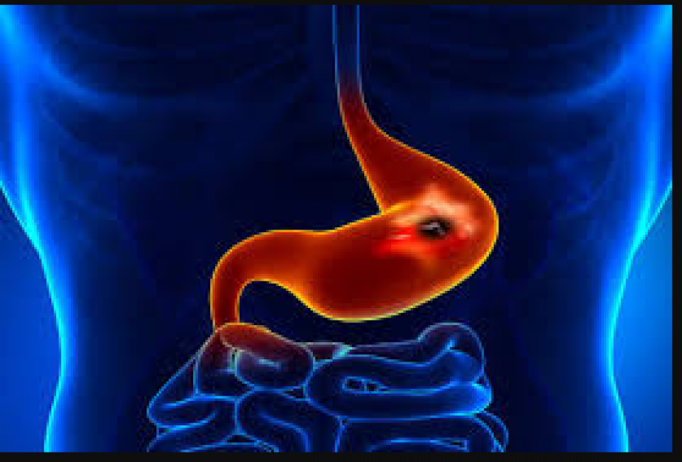 Do not ignore stomach ulcers, these are symptoms and treatment