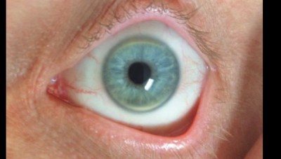 आंखों में दिखने वाले ये 3 लक्षण बताते हैं बढ़ गया है आपका कोलेस्ट्रॉल लेवल
