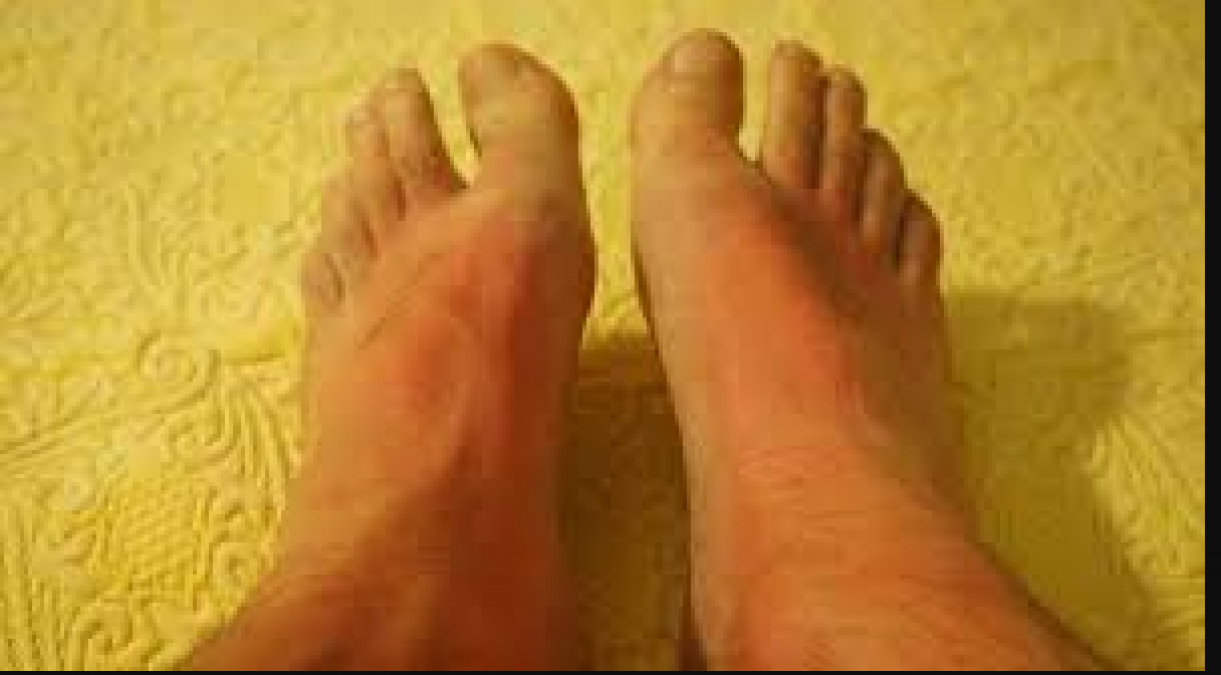 If you are troubled by the problem of burning feet, immediately consult a Doctor