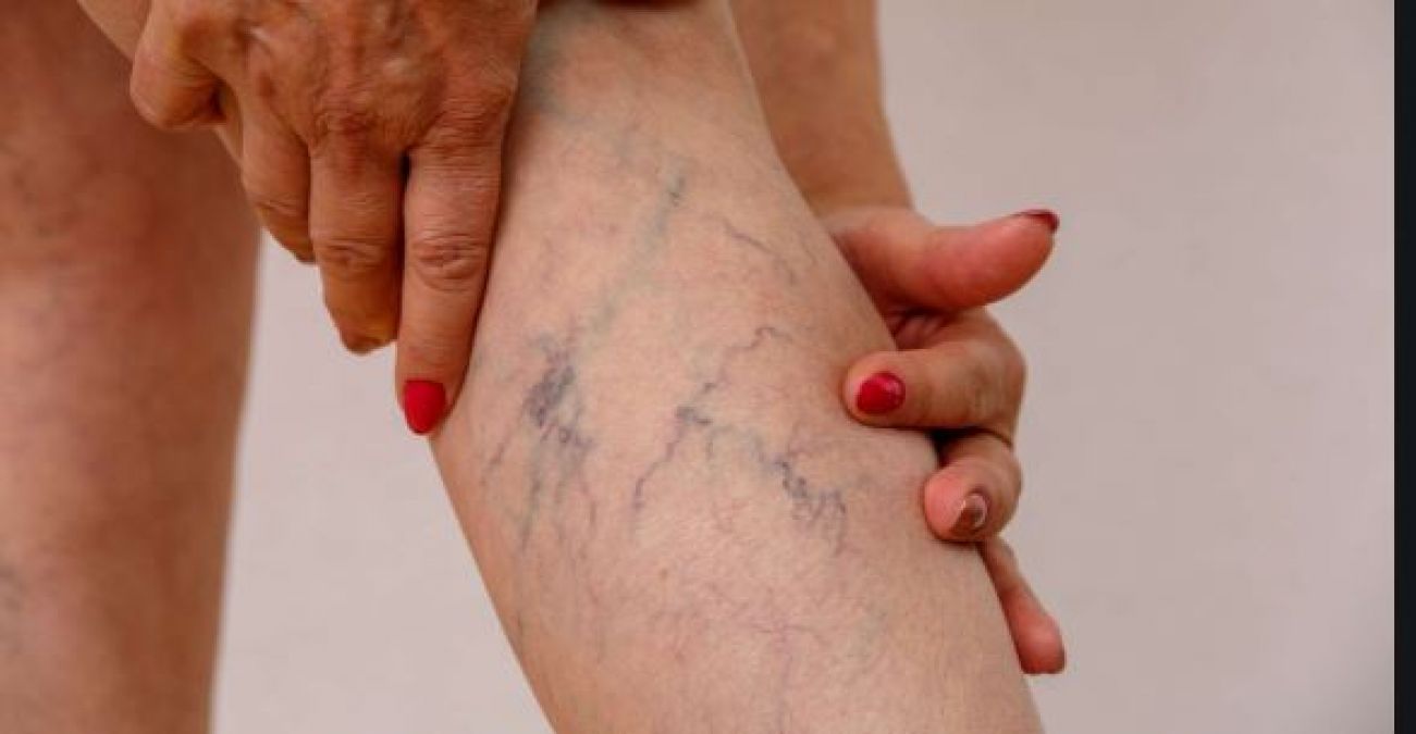 After all, why are blue veins visible on legs, know the reason and prevention