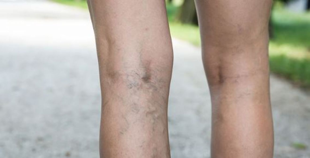 After all, why are blue veins visible on legs, know the reason and prevention