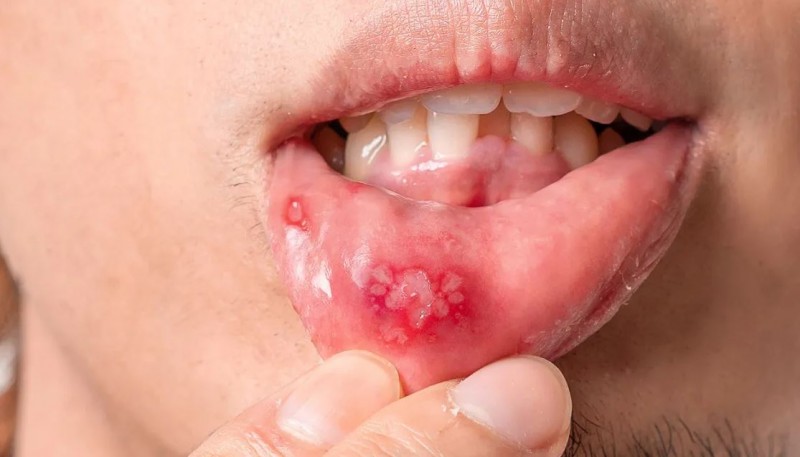 Don't Overlook Frequent Ulcers; They Could Lead to Serious Illness