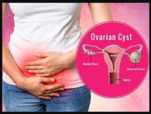 Know what is ovarian cyst problems and how to deal with it
