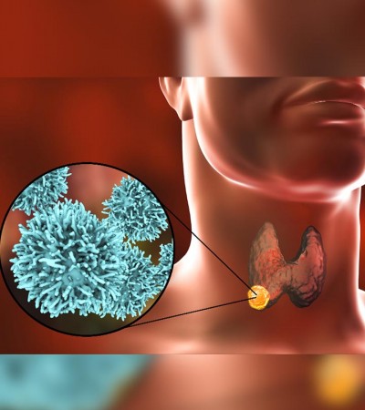 Know the symptoms of Thyroid