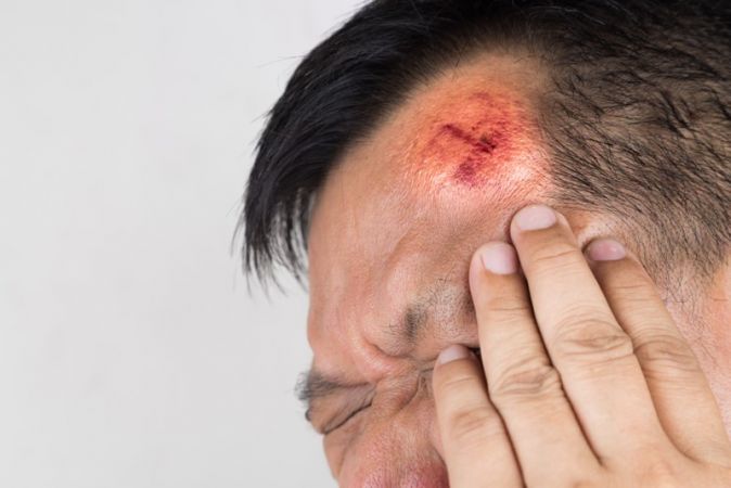 सिर की छोटी सी चोट दे सकती है आपको बड़ी तकलीफ, जानिए फेक्ट