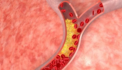 How to Control Cholesterol in Patients with Serious Diseases: Experts' Opinions