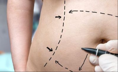 Tummy Tuck Surgery is beneficial for lowering abdominal fat, keep these things in mind
