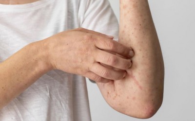 These 5 Home Remedies Will Prevent Fungal Infections