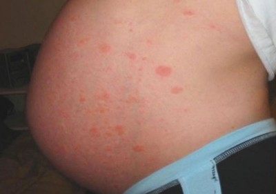 Can Women Get Rashes on Their Body During Pregnancy? Know the Causes and Ways to Prevent Them