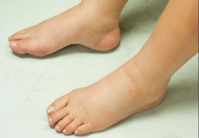 Know What Are The Causes Of Body Swelling, Adopt these Domestic Ways