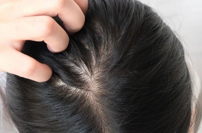 Itching in the Head Due to Humid Weather? Get Rid of It with These Tips