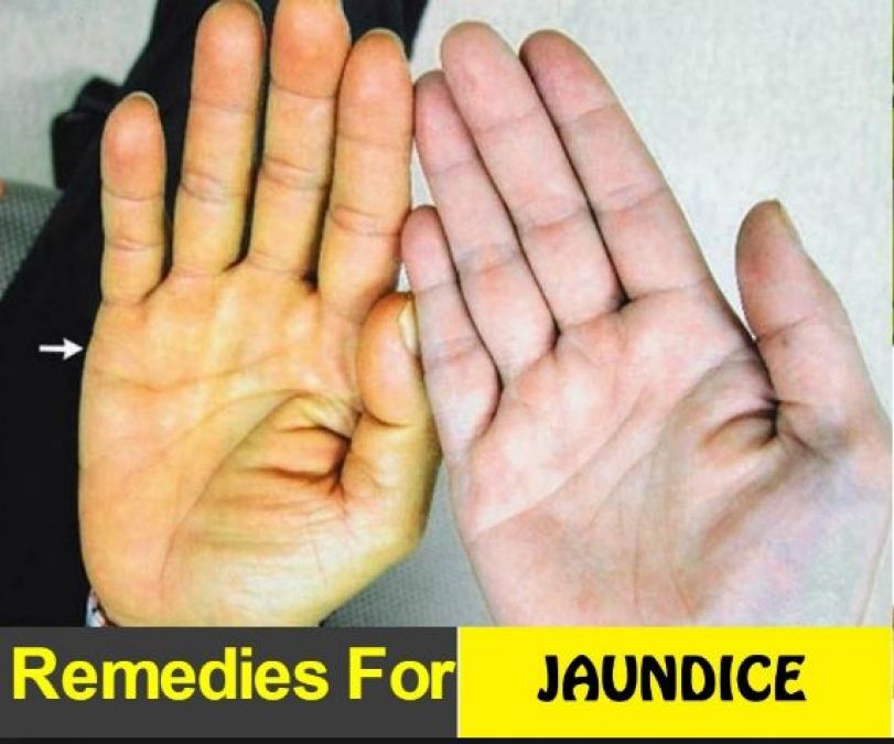 Diet for jaundice recovery: These things can give immediate relief