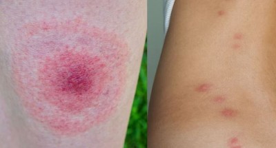 If You Get Bitten by an Insect During the Rainy Season, Don’t Panic—Try This Remedy for Relief