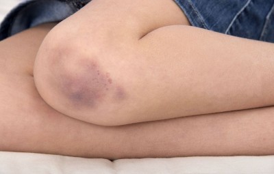 Can Bruises Appear on the Body Without Injury? Don't Ignore This Potential Reason.