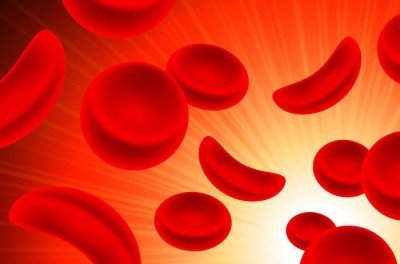 Understanding Sickle Cell Disorder: Symptoms and Prevention Measures