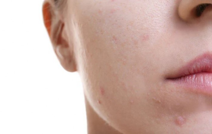 Do You Get Acne on Your Face Due to Periods? Here's How to Get Rid of It