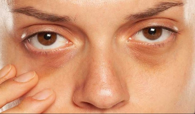 Troubled by Dark Circles and Loose Skin Under the Eyes? Here's How to Get Rid of Them.