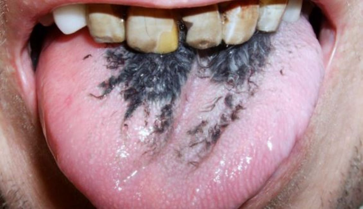 Smoking a cigarette caused the tongue to fall black and grown hair, strange disease came to the fore