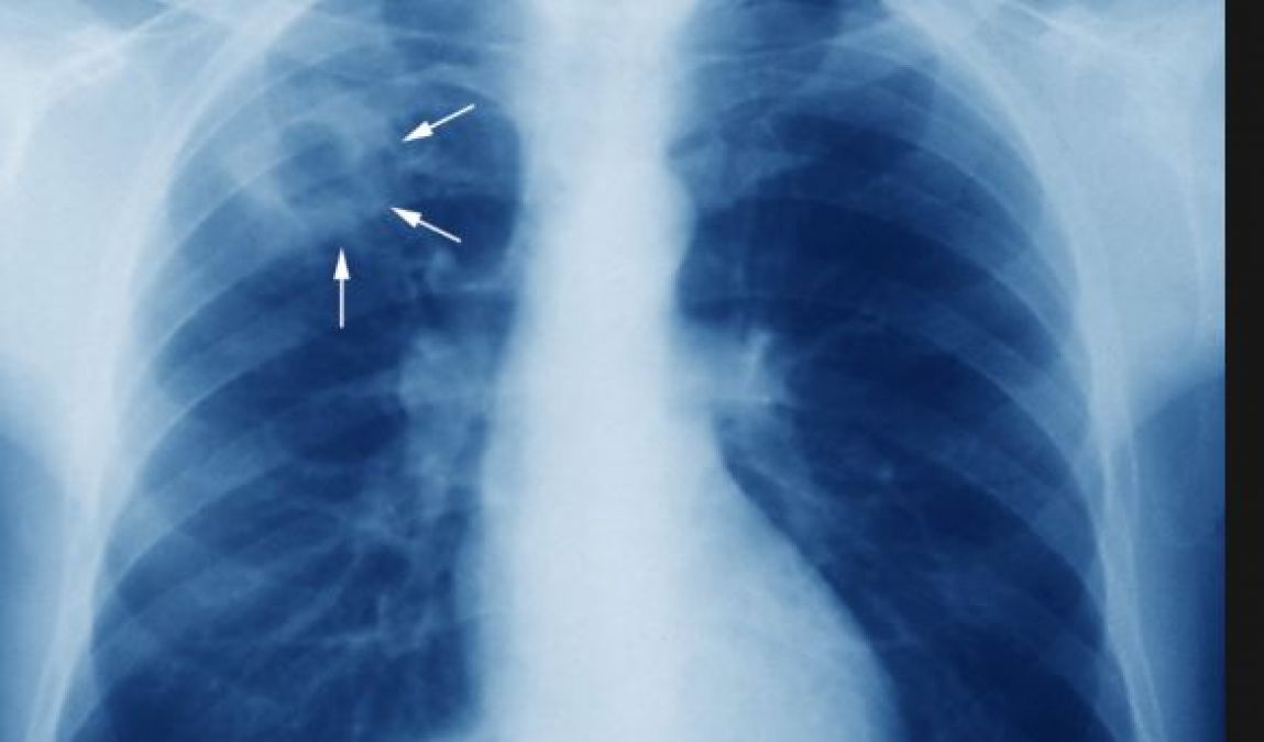 What are the symptoms, causes and treatment of TB, know everything here