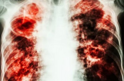 What are the symptoms, causes and treatment of TB, know everything here