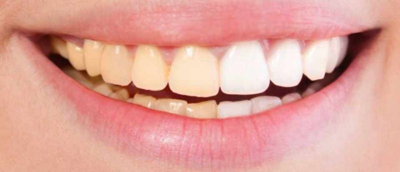 इन उपायों से आप भी चमका सकते है अपने पीले दांत