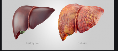 This substance can eliminate the problem of fatty liver disease