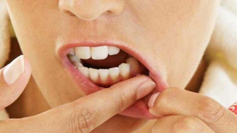 This home remedy is helpful in curing gum swelling