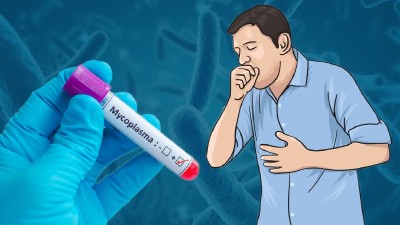 निमोनिया के अलग-अलग प्रकार, जानिए क्यों वाकिंग निमोनिया है घातक