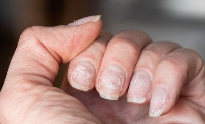 How to Handle Frequent Nail Breakage: Don't Ignore It, as It Could Indicate a Serious Issue