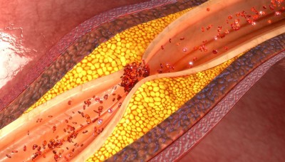 How to Increase Good Cholesterol in the Body? Find Out Here