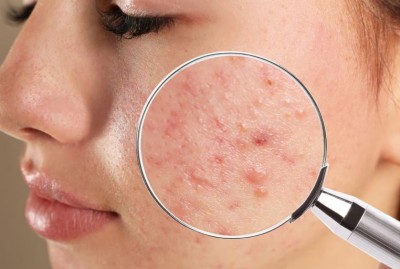 How to Keep Your Skin Pimple-Free in Summer