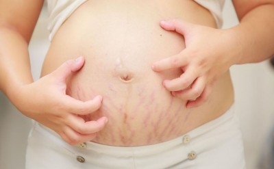 If You Are Troubled by Itching on the Stomach During Pregnancy, Find Relief with These Remedies