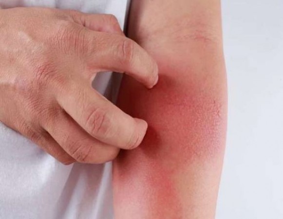 Adopt these home remedies to get rid of itching and ringworm