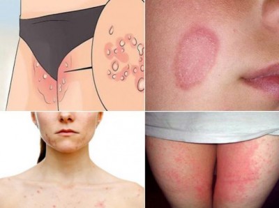 Try these home remedies to cure ringworm