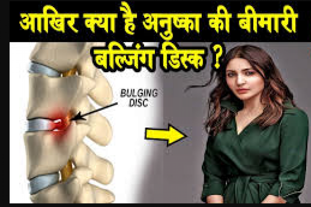 Do you know about the problem of bulging disc, actress Anushka Sharma is also a victim of it